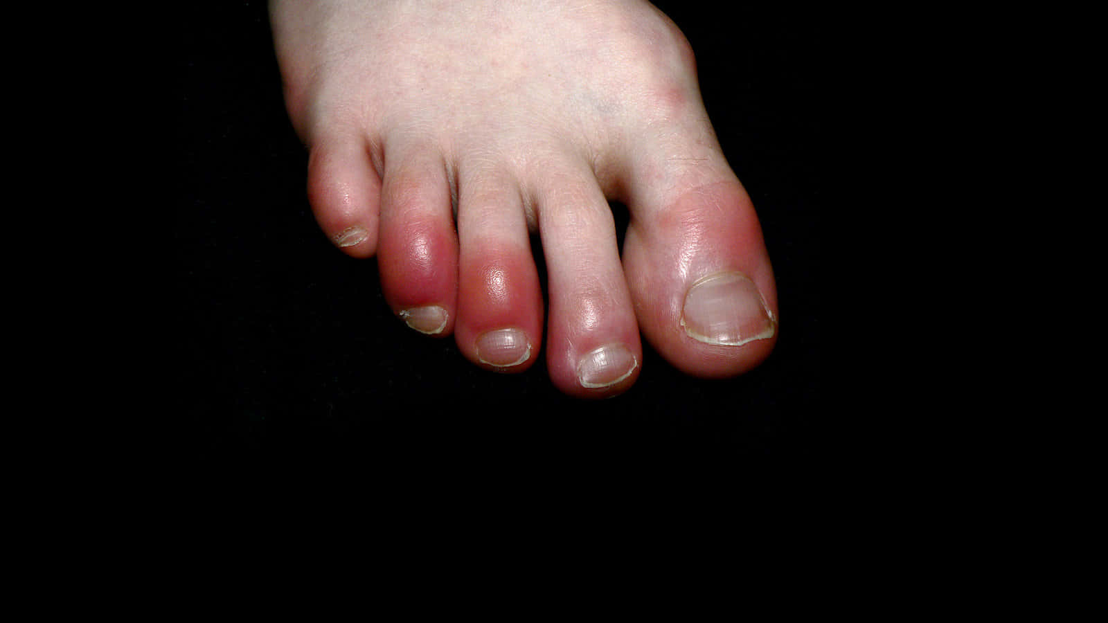 A Close-up View Of Covid Toes Syndrome Background