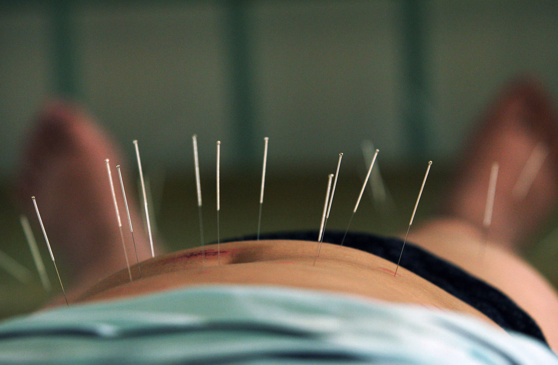 A Professional Acupuncturist Practicing Alternative Medicine, Using Needles On Patient's Abdomen.