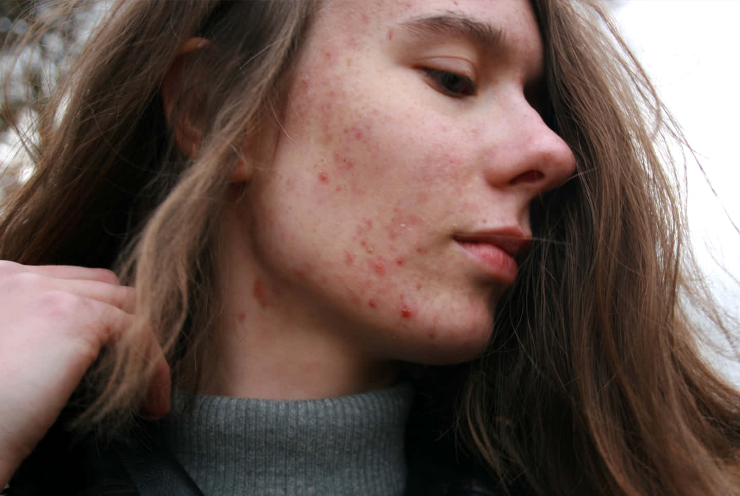 Acne Affected Skin Portrait