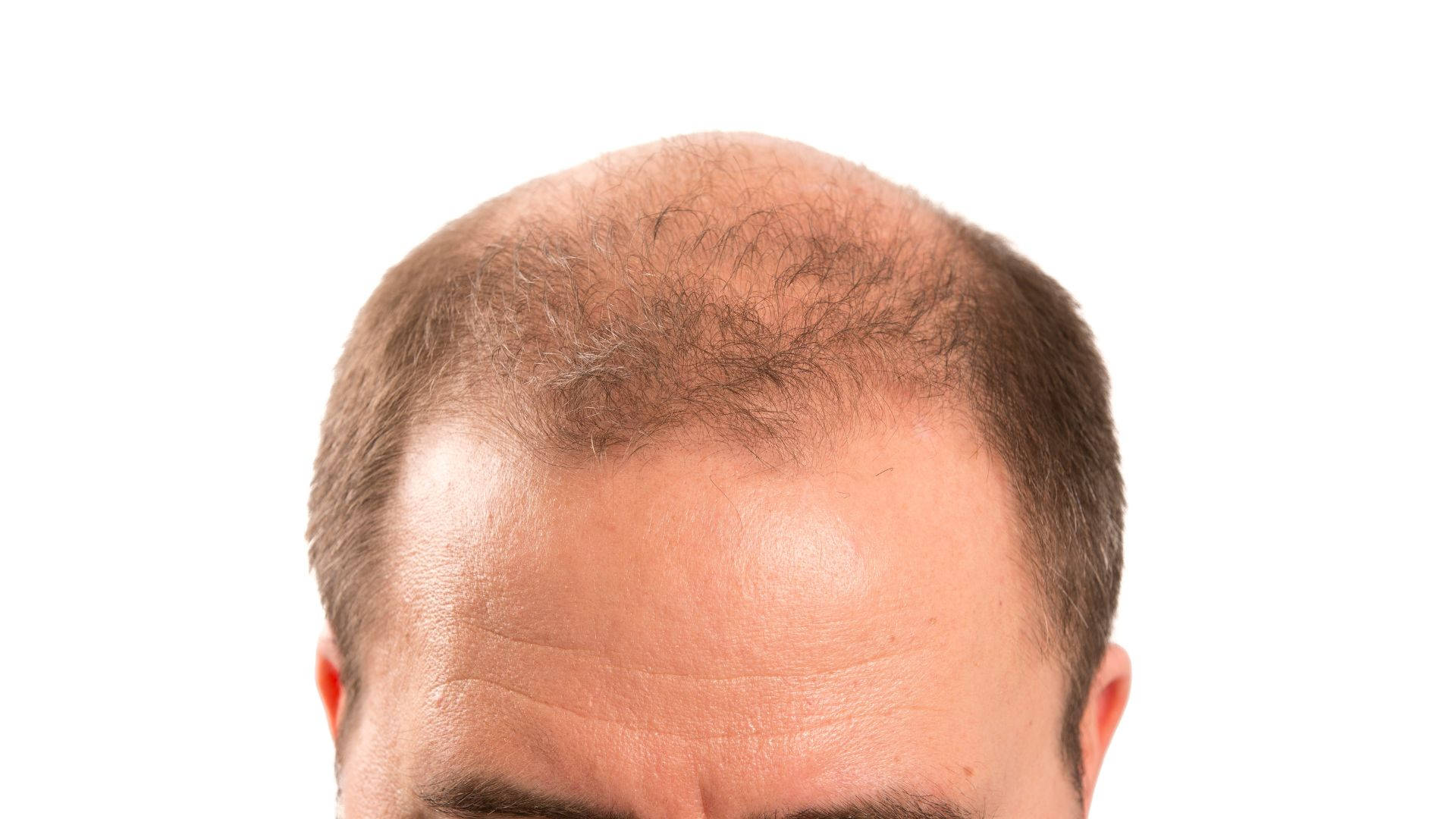 Bald Man With Fading Thin Hair Background