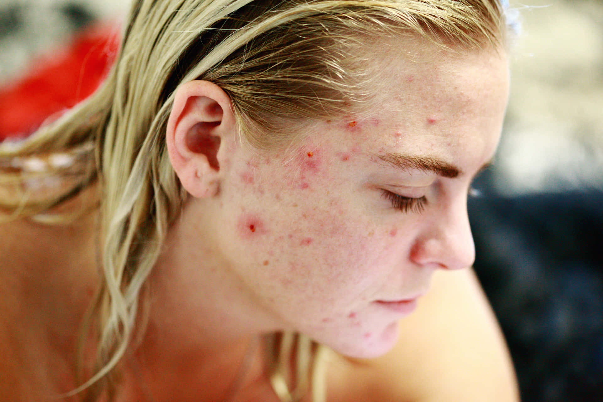 Bruised Girl Side View Background
