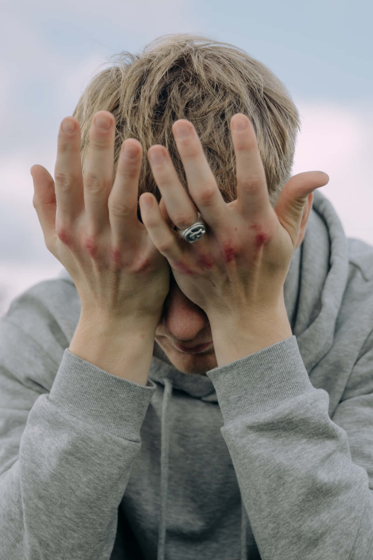 Bruised Hands Covering Eyes