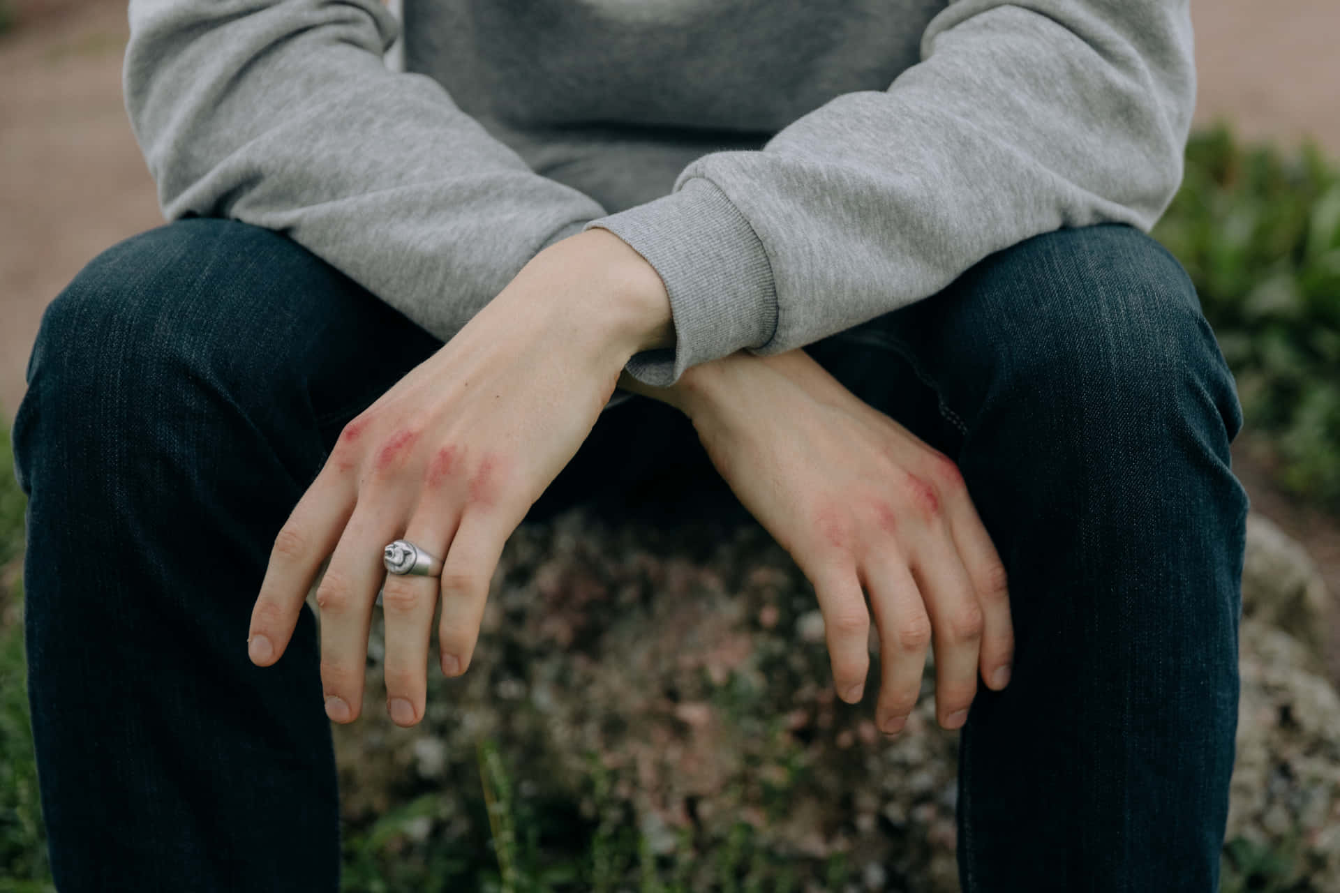 Bruised Knuckles Over Lap