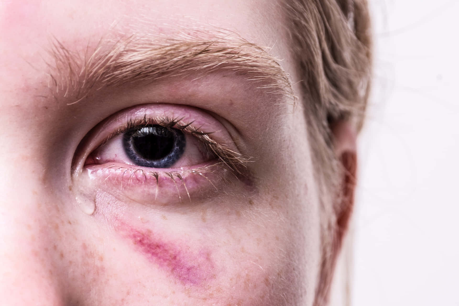 Bruised With Teardrop Background