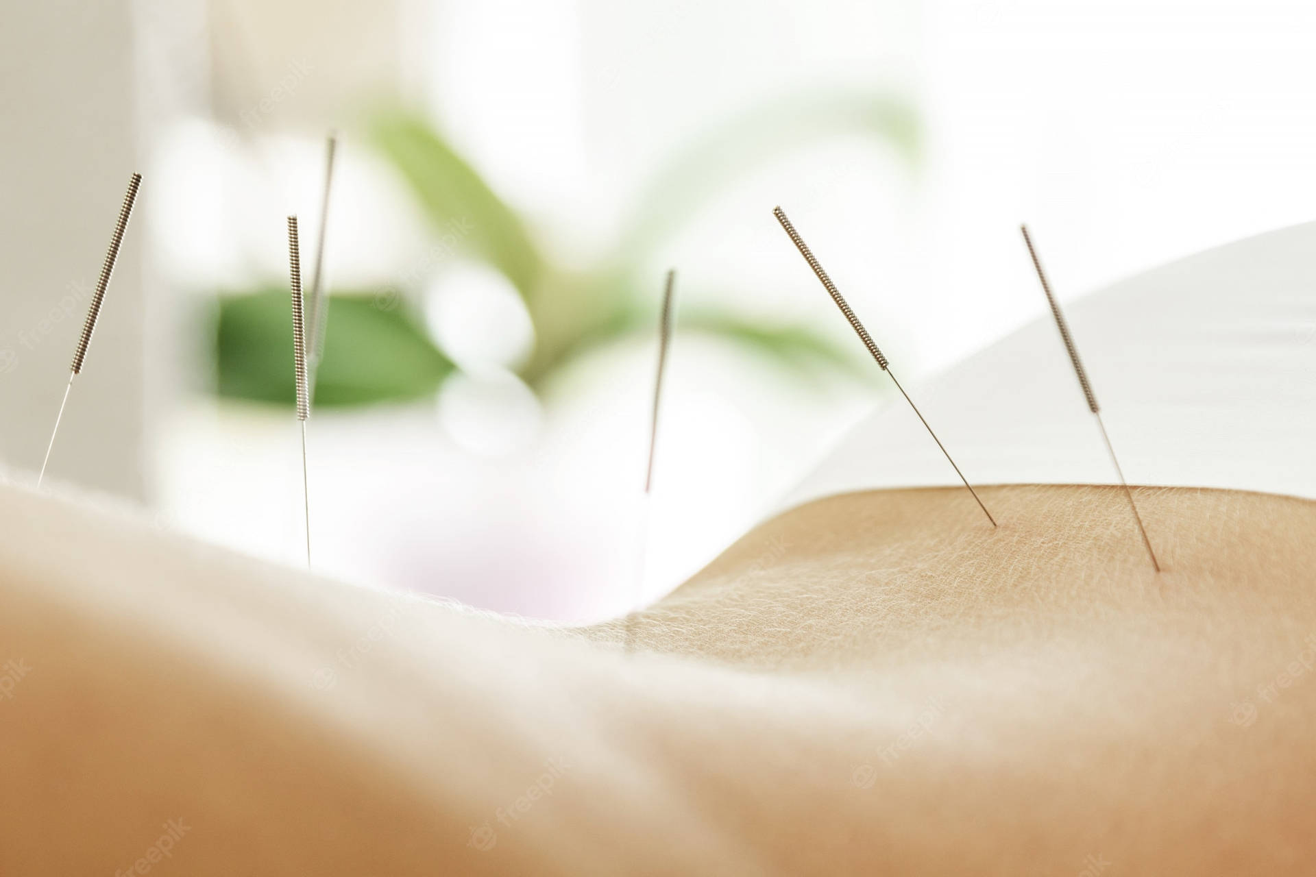 Caption: Experienced Acupuncturist Performing Back Needle Therapy