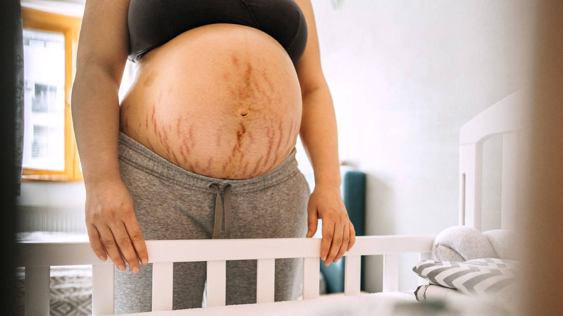 Close-up Shot Of A Pregnant Belly With Beautiful Stretch Marks Background