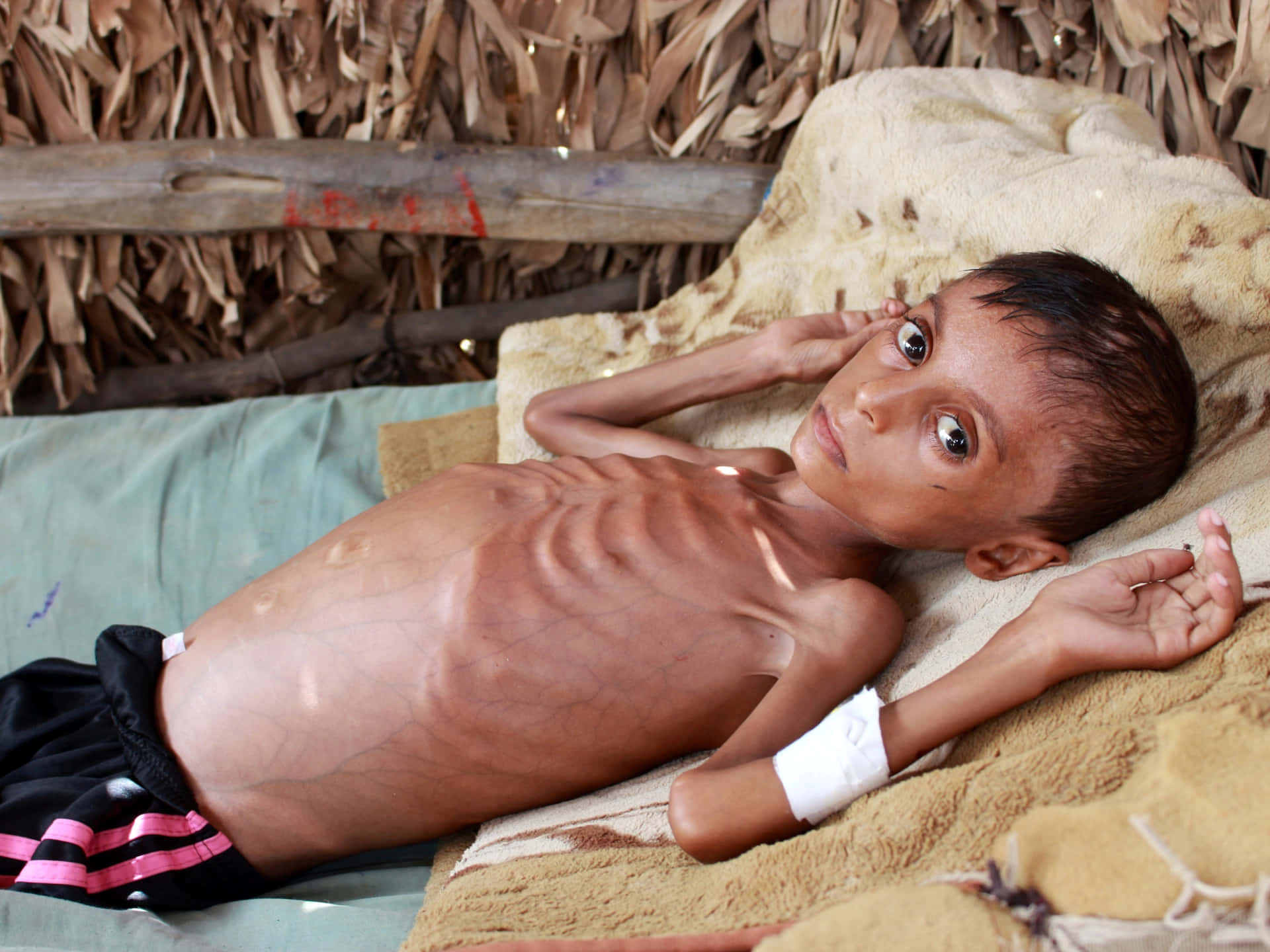 Emaciated Boy Lying On Bed