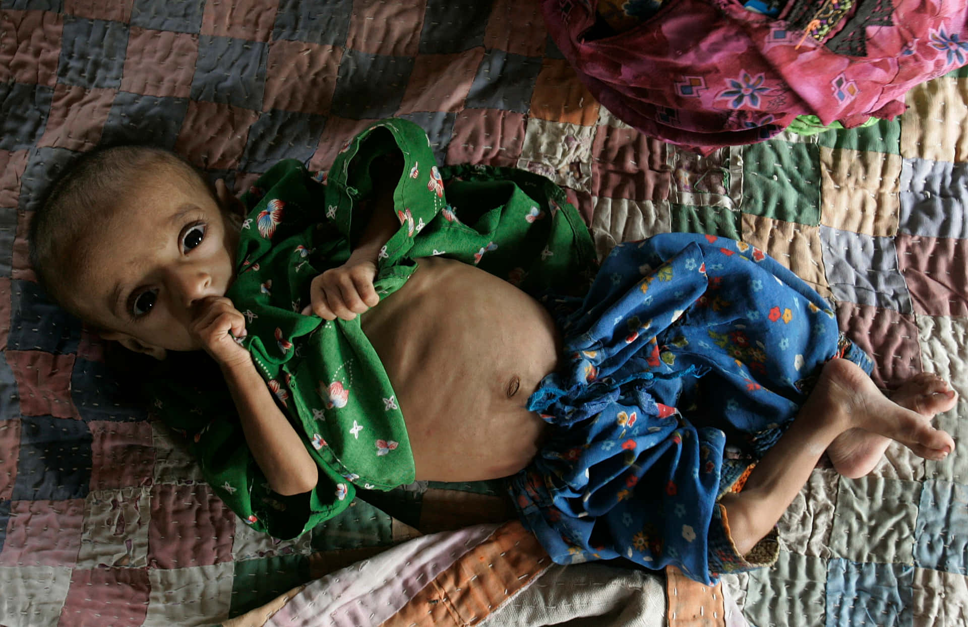 Emaciated Child With A Big Stomach Background