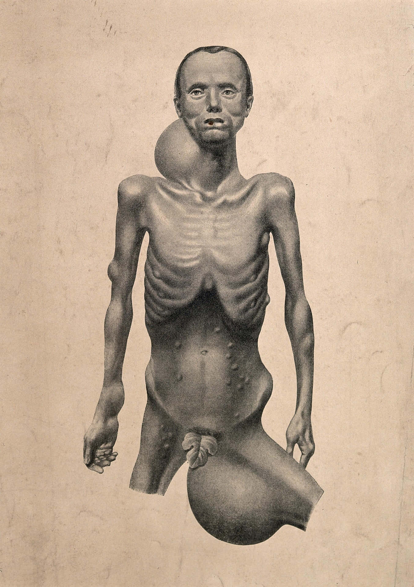 Emaciated Man With Swellings Background