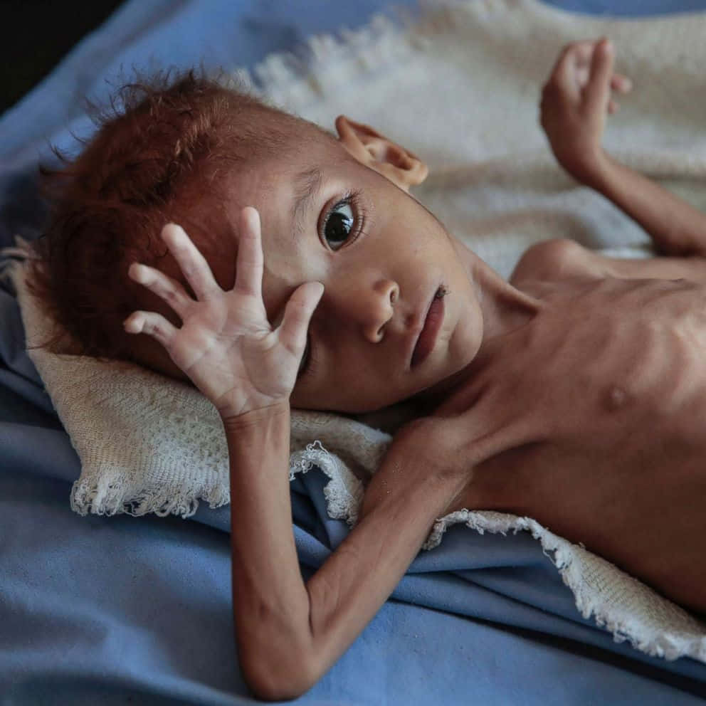 Heart-wrenching Image Of An Emaciated Boy Background