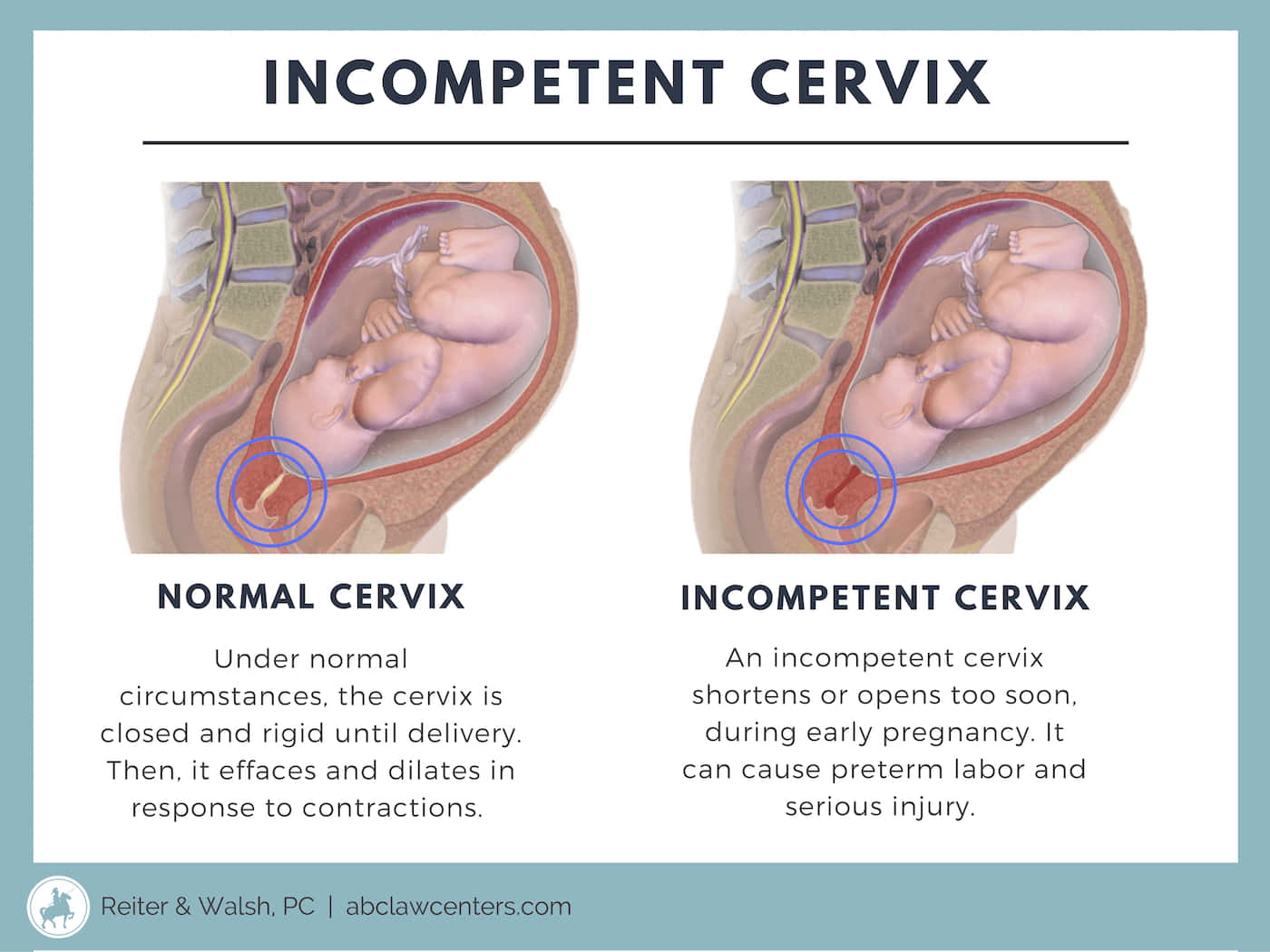 Incompetent Cervix Background