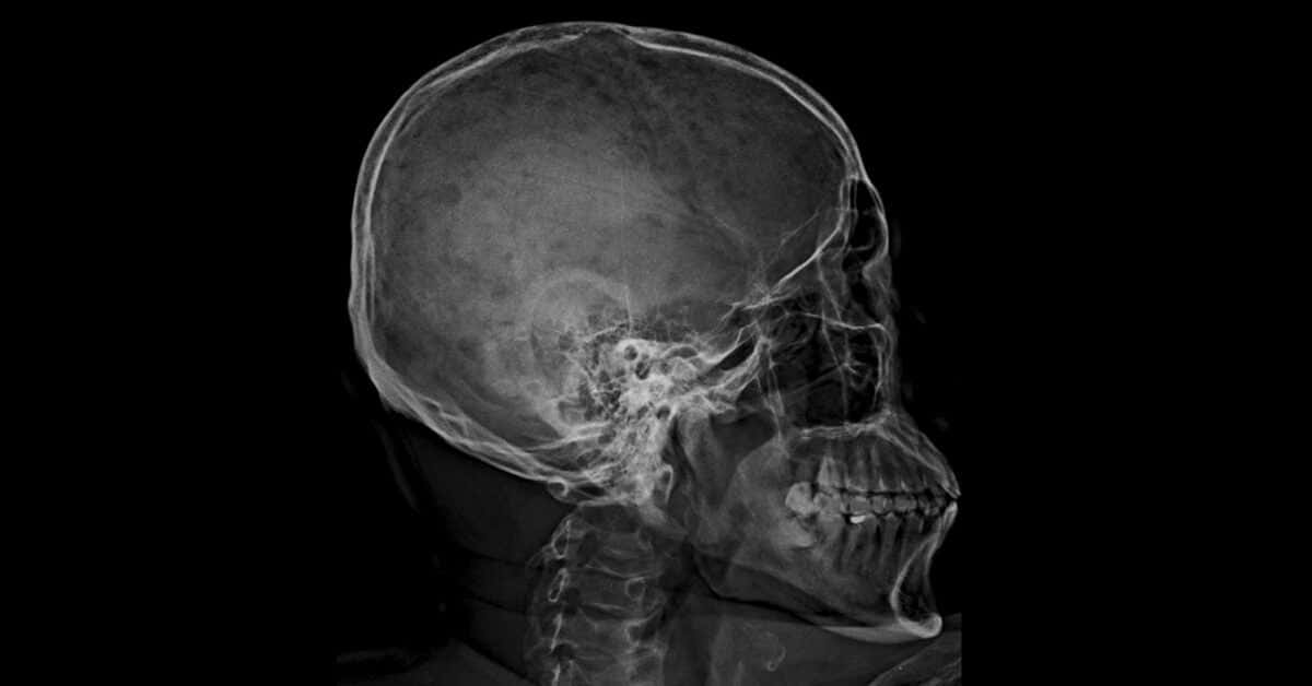 Internal Glimpse Using X Rays