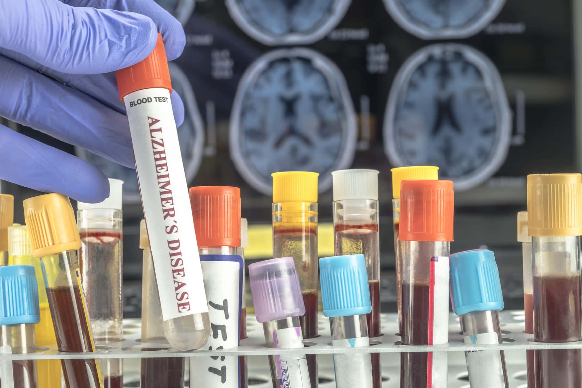 Laboratory Blood Sample Alzheimer's Background