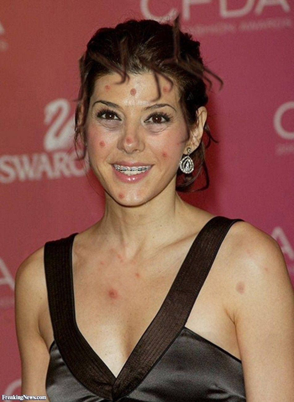 Marisa Tomei Dental Braces