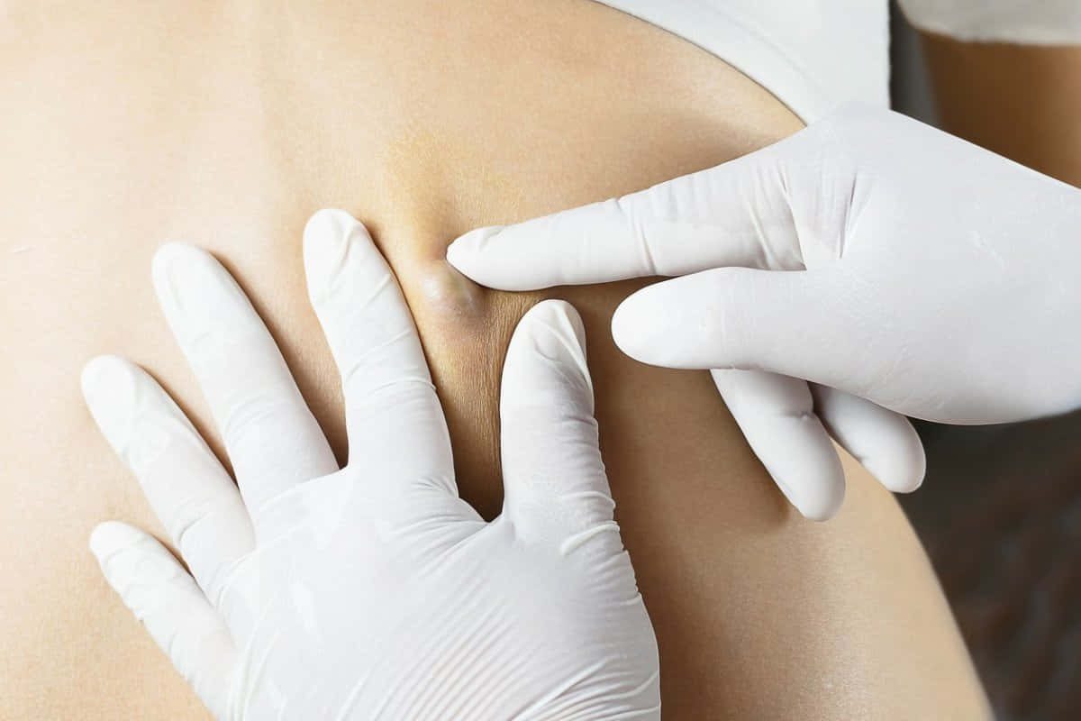 Popping Back Acne [wallpaper] Background