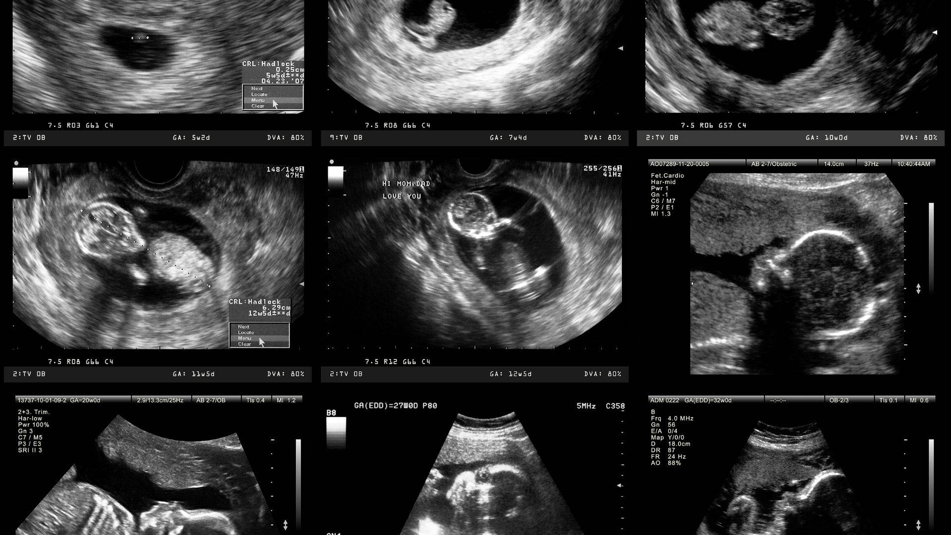 Pregnancy Ultrasound Photos