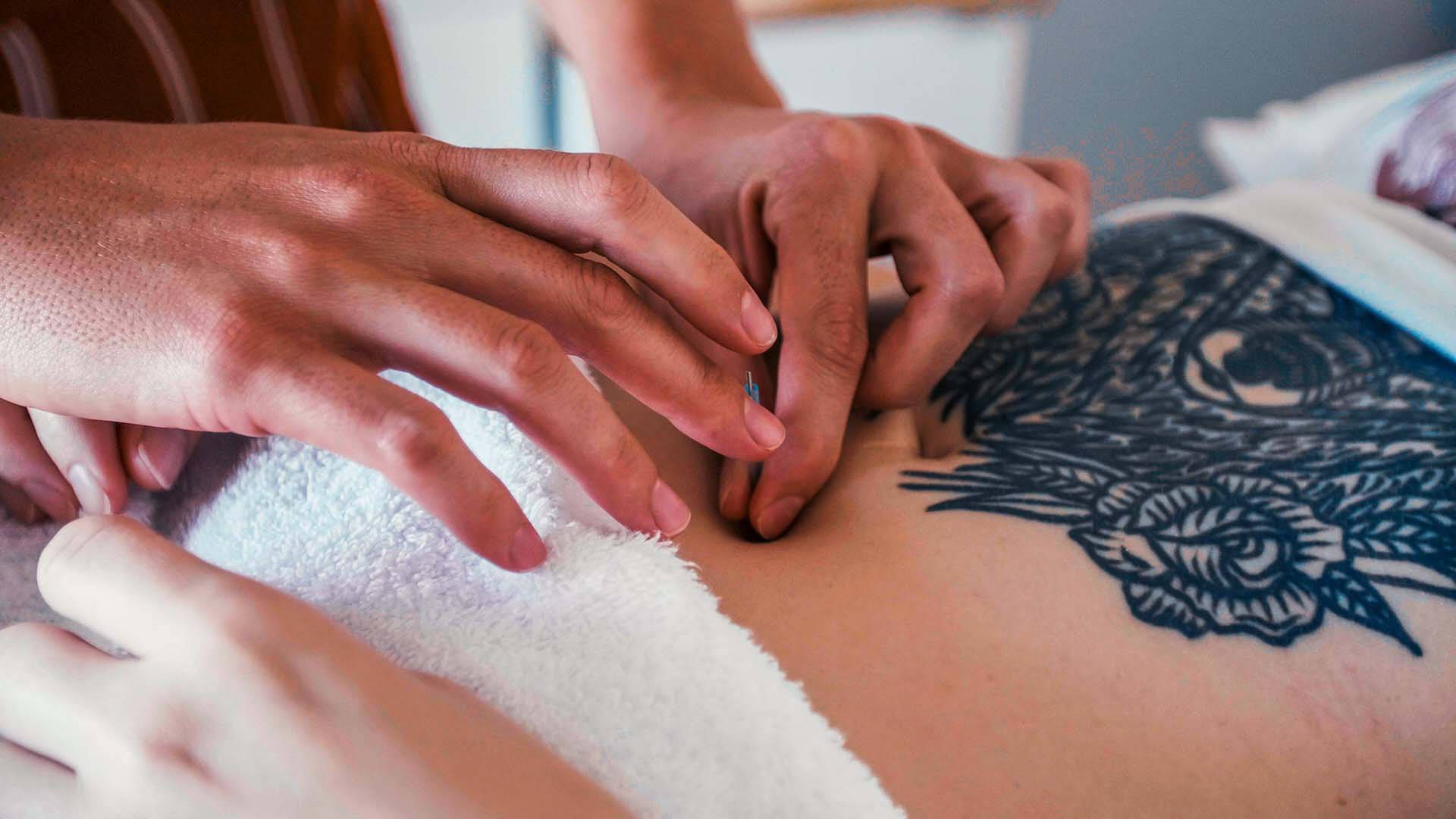 Skilled Acupuncturist Performing Needle Therapy On A Patient's Back Background