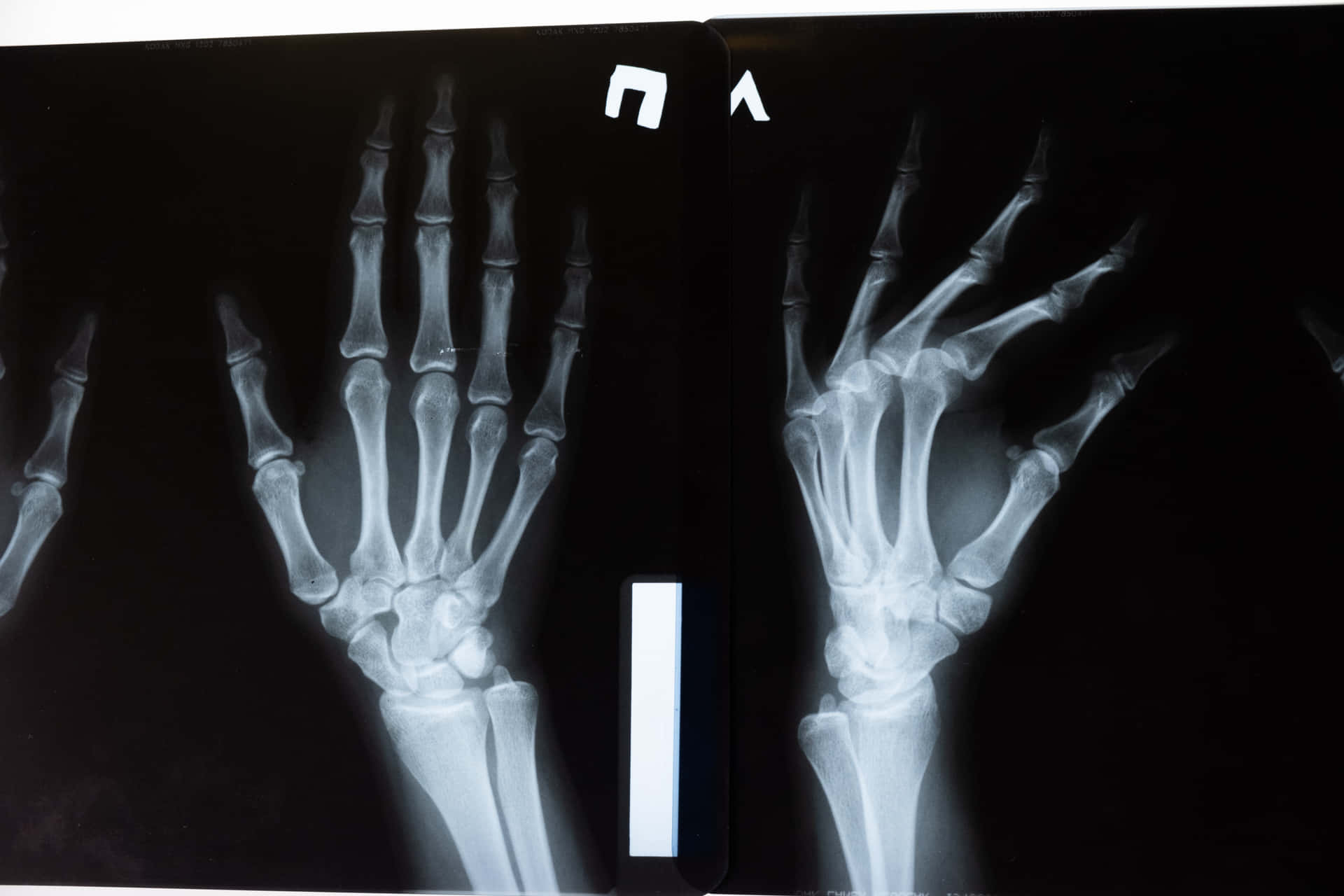X-rays Of The Hands Of Two People Background