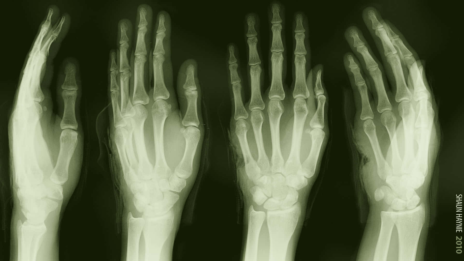 X-rays Of The Hands Of Two People